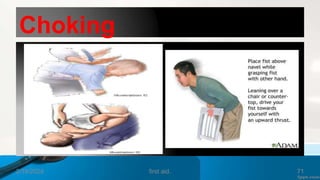 Choking
Infant
2/18/2024 first aid. 71
 