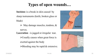 Types of open wounds…
Incision: is a break in skin caused by
sharp instruments (knife, broken glass or
blade)
 May damage muscles, tendons, &
nerves.
Laceration - is jagged or irregular tear.
Usually causes when great force is
exerted against the body
Bleeding may be rapid & extensive.
Incision
first aid.
2/18/2024 79
 