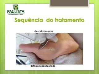 Sequência do tratamento
Estágio supervisionado
desbridamento
 