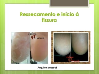 Ressecamento e início á
fissura
Arquivo pessoal
 