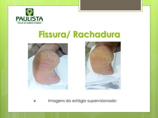 Fissura/ Rachadura
 Imagens do estágio supervisionado
 