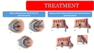 TREATMENT
Notaras Closed blind subcutaneous lateral internal
sphincterotomy
Open subcutaneous lateral internal
sphincterotomy
 