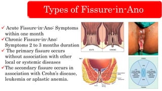 Types of Fissure-in-Ano
 Acute Fissure-in-Ano: Symptoms
within one month
Chronic Fissure-in-Ano:
Symptoms 2 to 3 months duration
 The primary fissure occurs
without association with other
local or systemic diseases
The secondary fissure occurs in
association with Crohn’s disease,
leukemia or aplastic anemia.
 