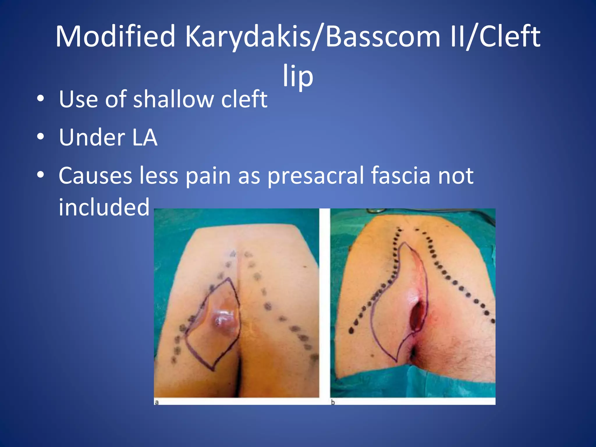 Modified Karydakis/Basscom II/Cleft
lip
• Use of shallow cleft
• Under LA
• Causes less pain as presacral fascia not
included
 
