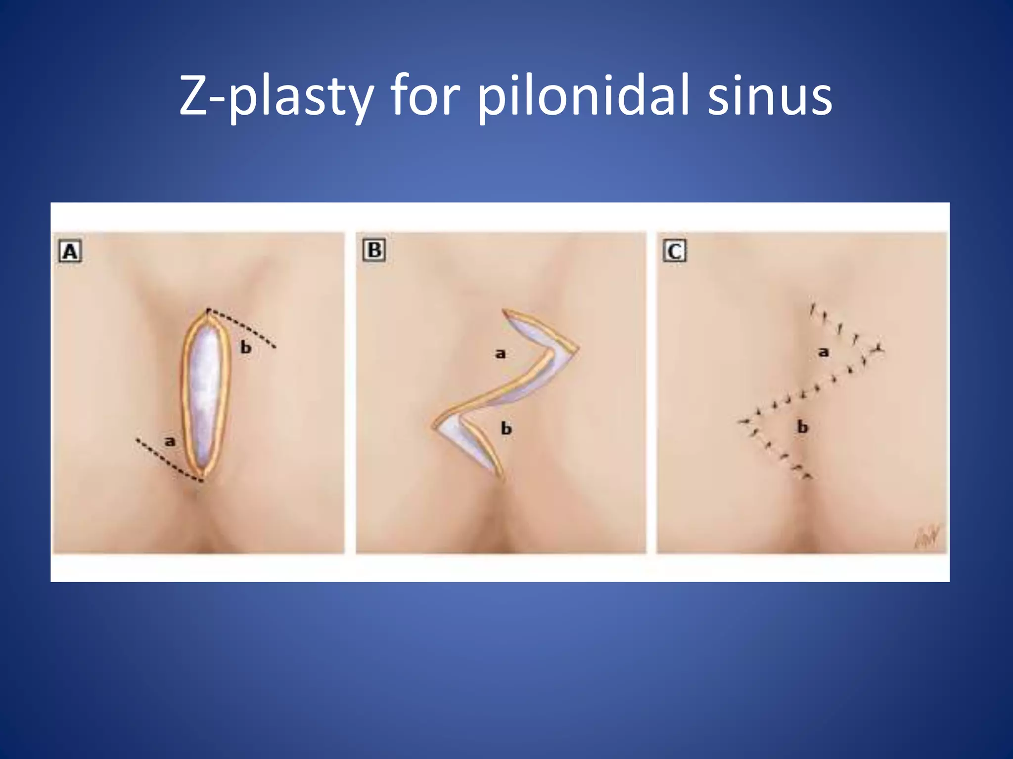 Z-plasty for pilonidal sinus
 