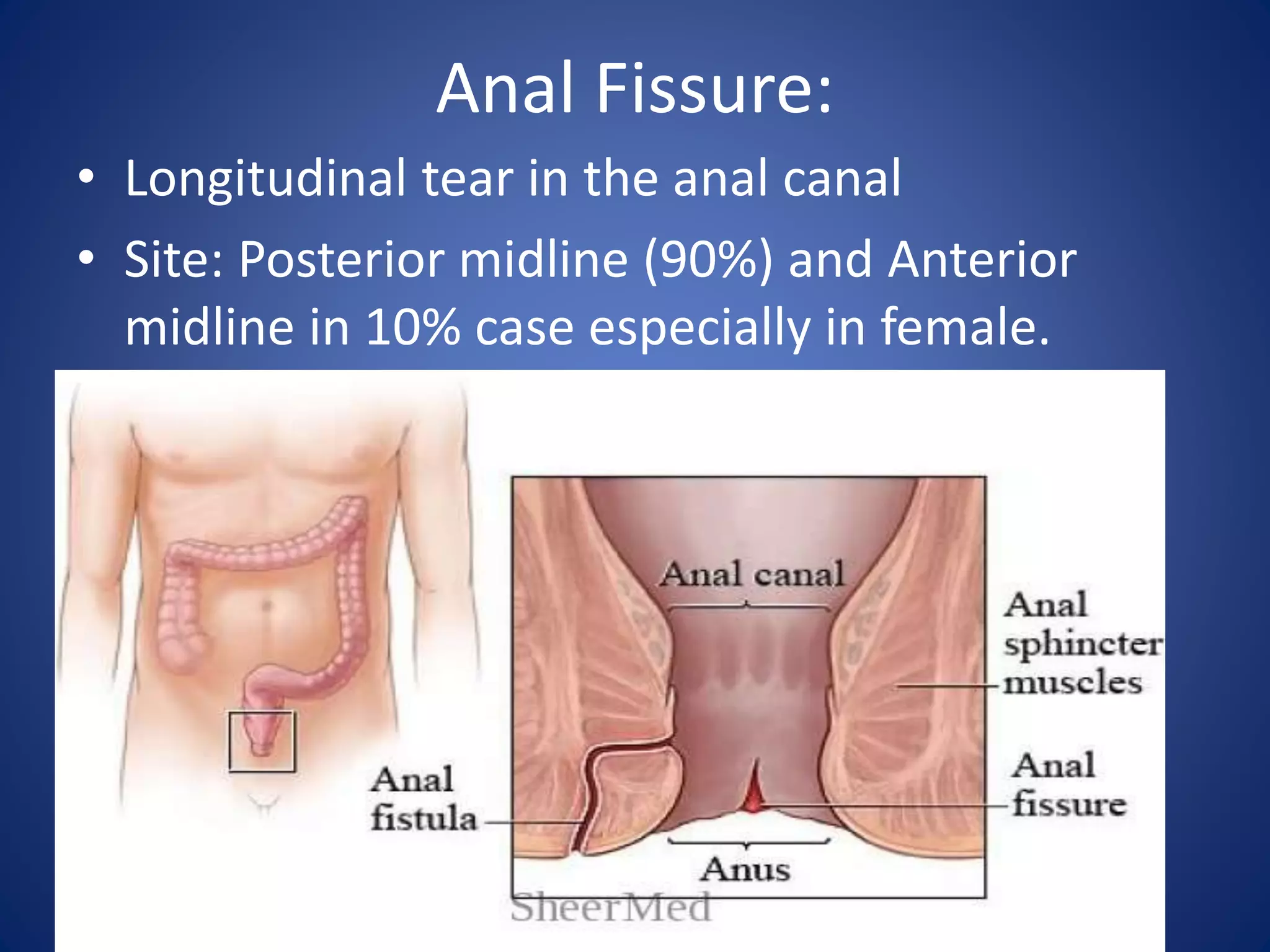 Anal Fissure:
• Longitudinal tear in the anal canal
• Site: Posterior midline (90%) and Anterior
midline in 10% case especially in female.
 