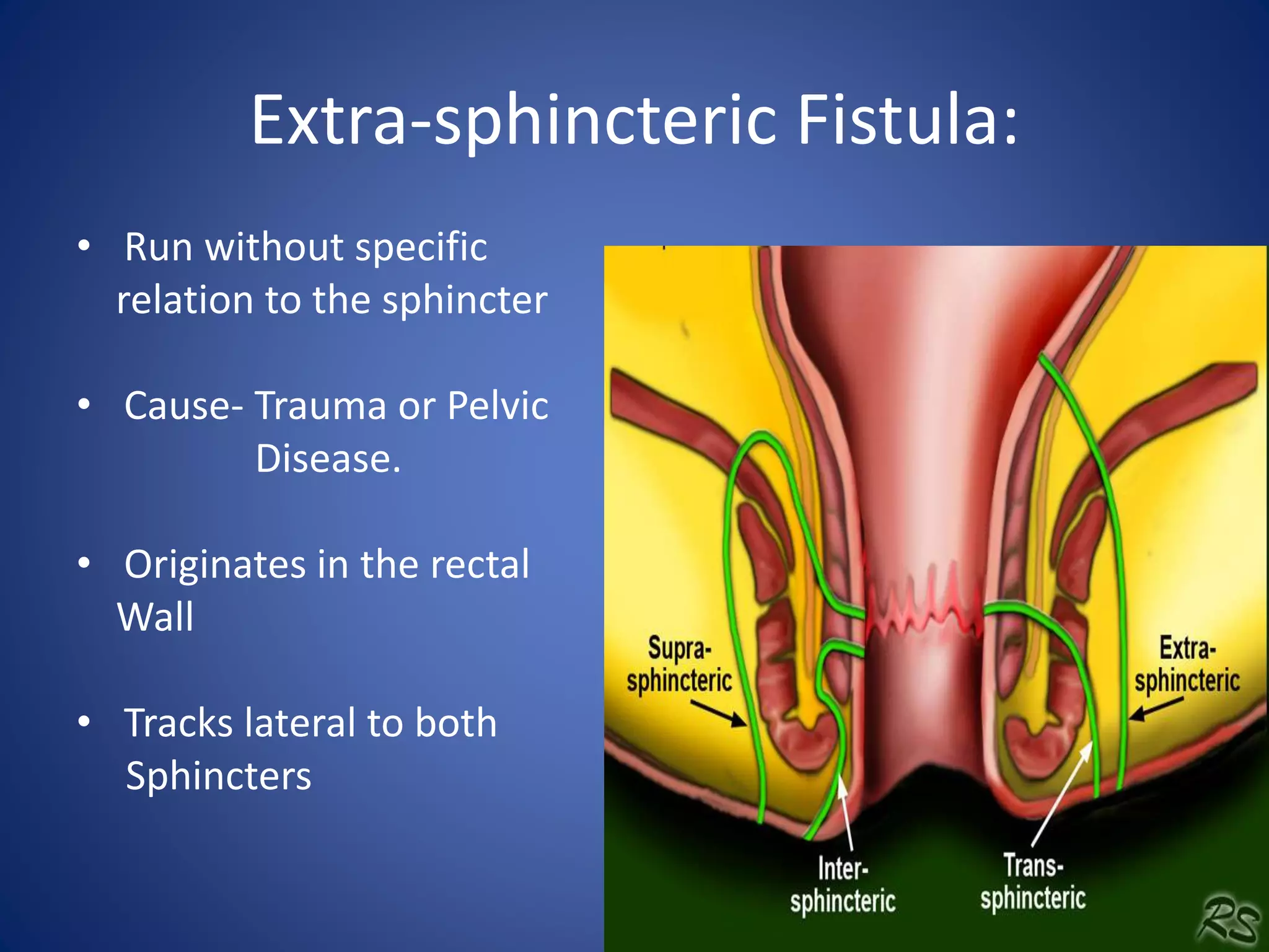 Extra-sphincteric Fistula:
• Run without specific
relation to the sphincter
• Cause- Trauma or Pelvic
Disease.
• Originates in the rectal
Wall
• Tracks lateral to both
Sphincters
 
