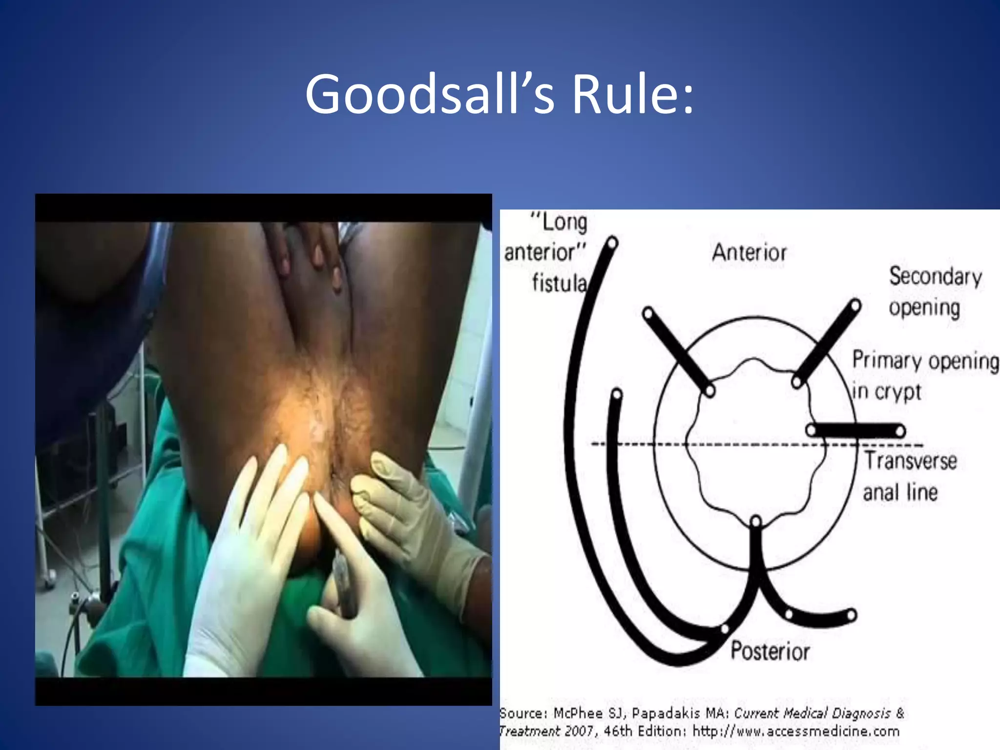 Goodsall’s Rule:
 
