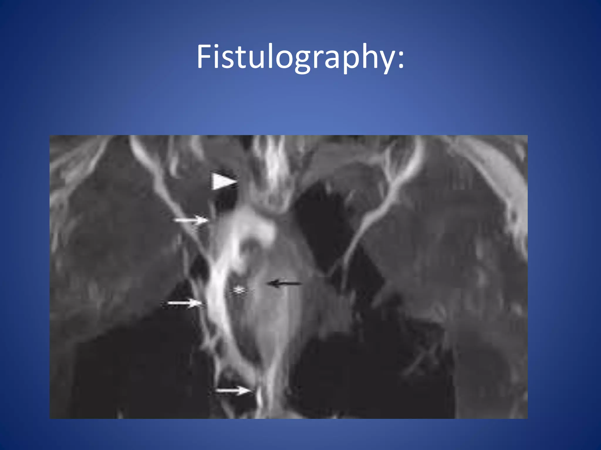 Fistulography:
 
