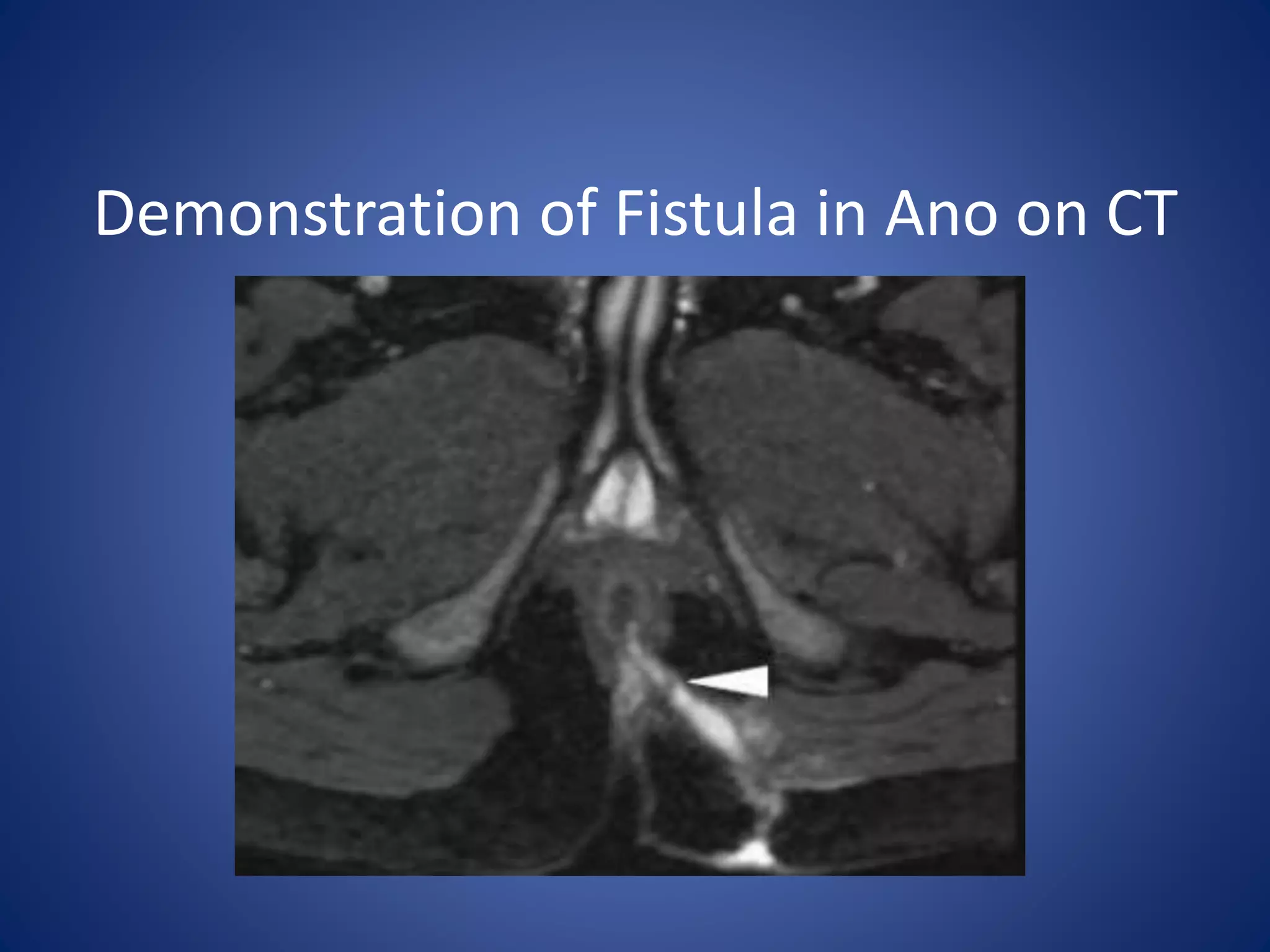 Demonstration of Fistula in Ano on CT
 