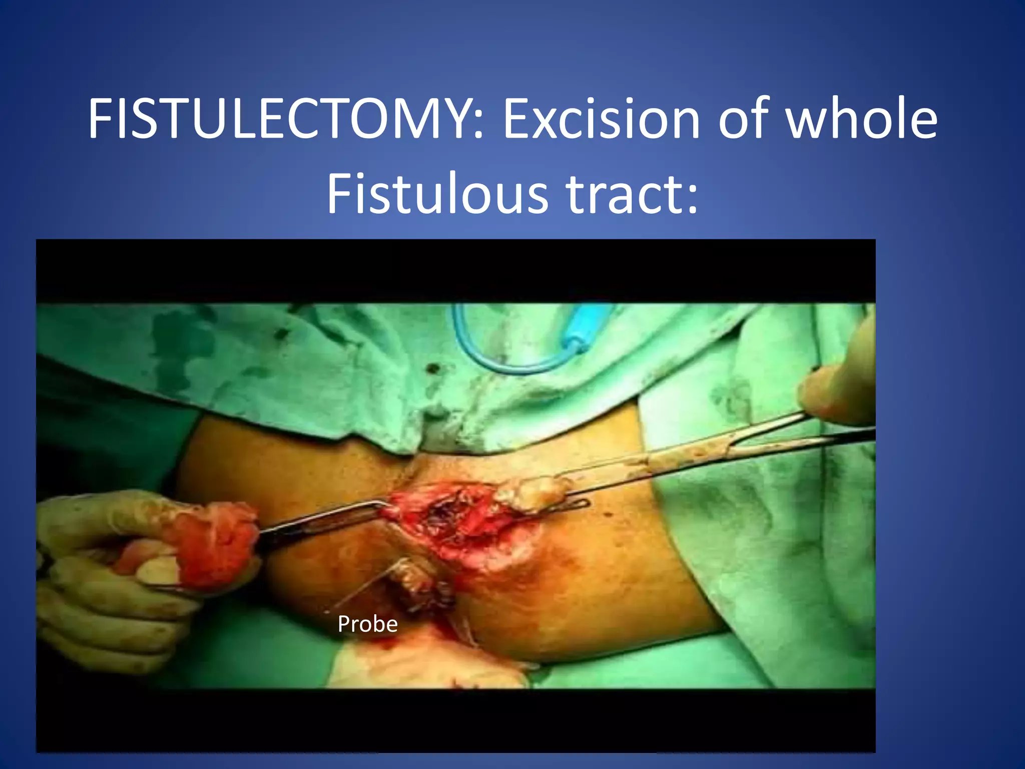 FISTULECTOMY: Excision of whole
Fistulous tract:
Probe
 