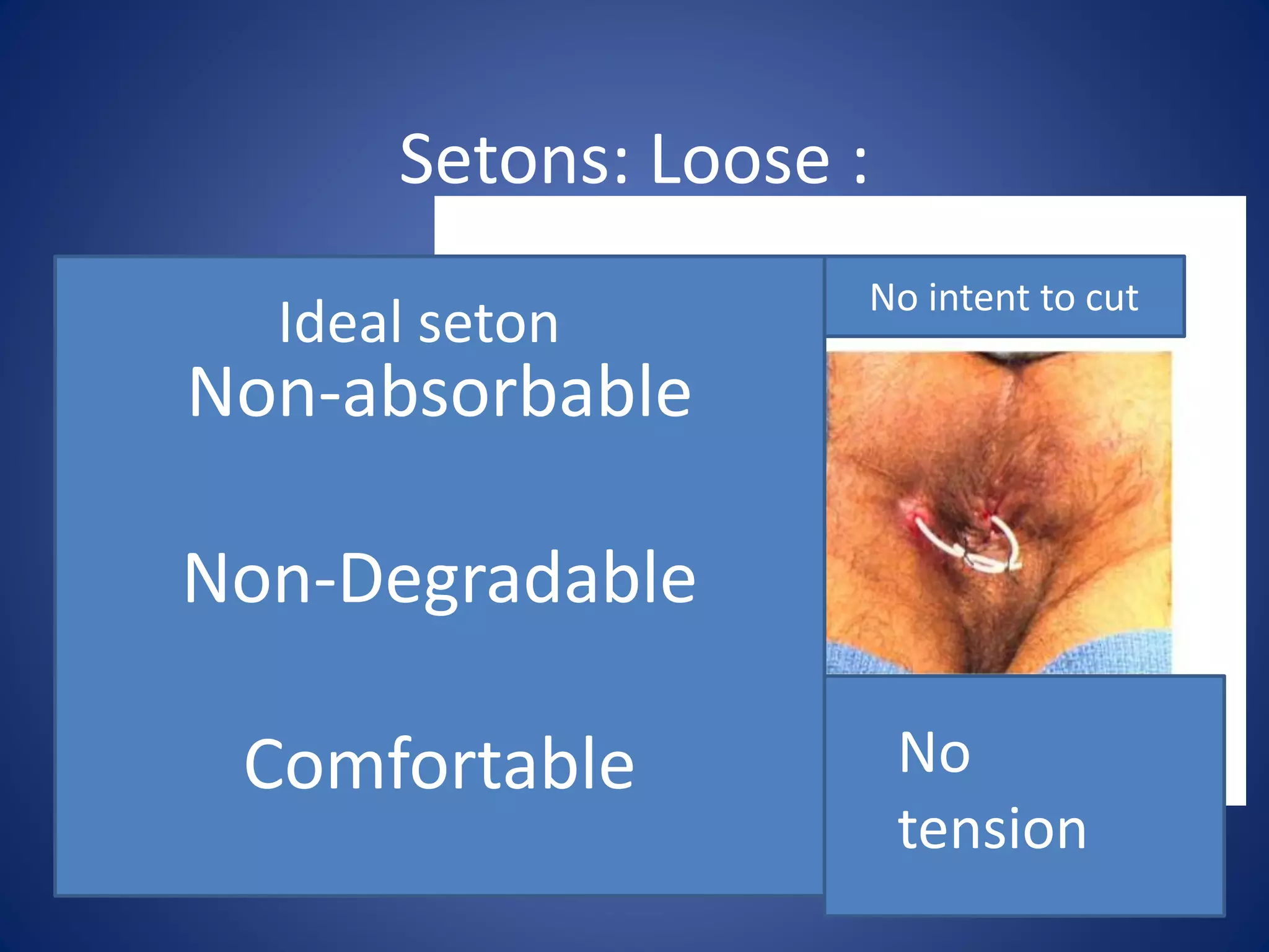 Setons: Loose :
seton
Non-absorbable
Non-Degradable
Comfortable
No intent to cut
Ideal seton
No
tension
 