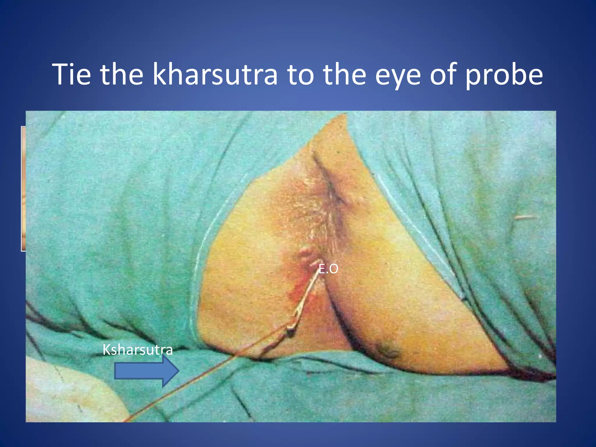 Tie the kharsutra to the eye of probe
E.O
Ksharsutra
 