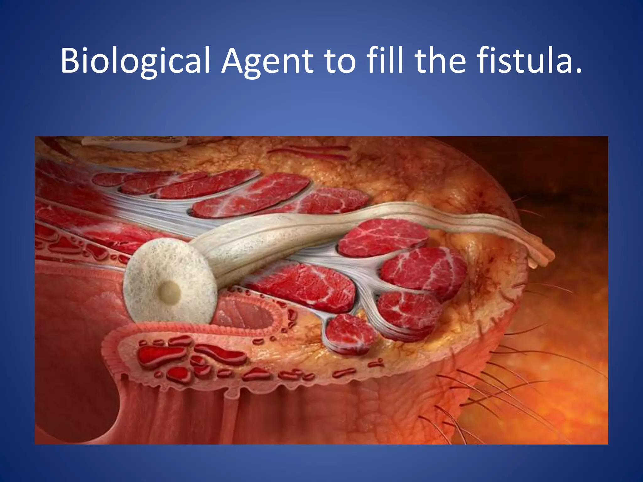 Biological Agent to fill the fistula.
 