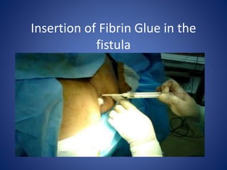 Fissure and fistula | PPTX