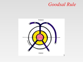 Goodsal Rule
 