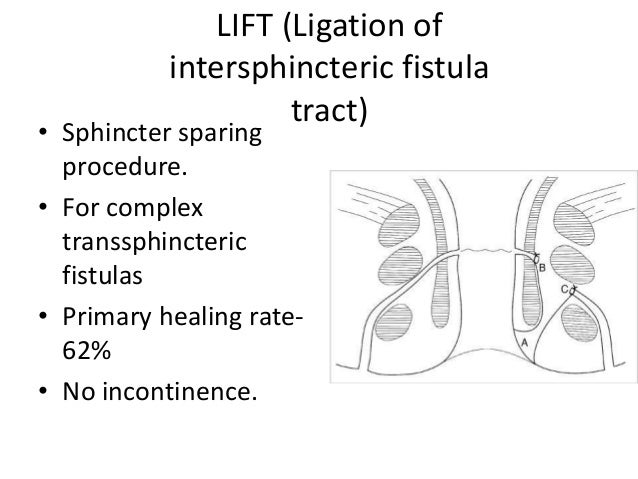 Fistula fistula