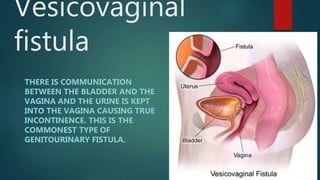Vesicovaginal
fistula
THERE IS COMMUNICATION
BETWEEN THE BLADDER AND THE
VAGINA AND THE URINE IS KEPT
INTO THE VAGINA CAUSING TRUE
INCONTINENCE. THIS IS THE
COMMONEST TYPE OF
GENITOURINARY FISTULA.
 