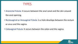 TYPES
• Anorectal Fistula: It occurs between the anal canal and the skin around
the anal opening.
• Rectovaginal or Anovaginal Fistula: Is a hole develops between the rectum
or anus and the vagina.
• Colovaginal Fistula: It occurs between the colon and the vagina.
 