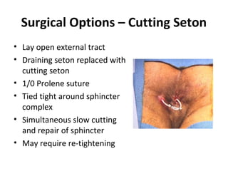 Surgical Options – Cutting Seton
• Lay open external tract
• Draining seton replaced with
  cutting seton
• 1/0 Prolene suture
• Tied tight around sphincter
  complex
• Simultaneous slow cutting
  and repair of sphincter
• May require re-tightening
 