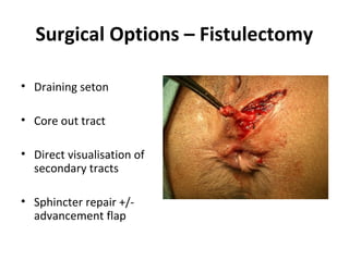 Surgical Options – Fistulectomy

• Draining seton

• Core out tract

• Direct visualisation of
  secondary tracts

• Sphincter repair +/-
  advancement flap
 