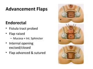 Advancement Flaps

Endorectal
• Fistula tract probed
• Flap raised
   – Mucosa + Int. Sphincter
• Internal opening
  excised/closed
• Flap advanced & sutured
 