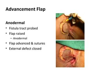 Advancement Flap

Anodermal
• Fistula tract probed
• Flap raised
   – Anodermal
• Flap advanced & sutures
• External defect closed
 