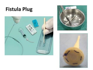 Fistula Plug
 