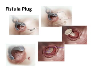 Fistula Plug
 