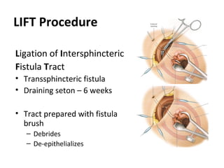 LIFT Procedure

Ligation of Intersphincteric
Fistula Tract
• Transsphincteric fistula
• Draining seton – 6 weeks

• Tract prepared with fistula
  brush
   – Debrides
   – De-epithelializes
 