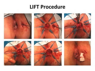 LIFT Procedure
 