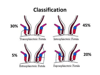 Classification

30%                    45%




5%                     20%
 