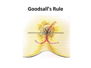 Goodsall’s Rule
 