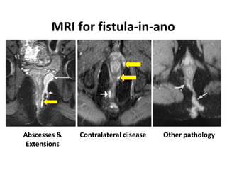 MRI for fistula-in-ano




Abscesses &   Contralateral disease     Other pathology
                                   HALLIGAN Radiology 2006
 Extensions
 