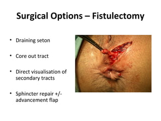 Advancement Flaps

Endorectal
• Fistula tract probed
• Flap raised
   – Mucosa + Int. Sphincter
• Internal opening
  excis...