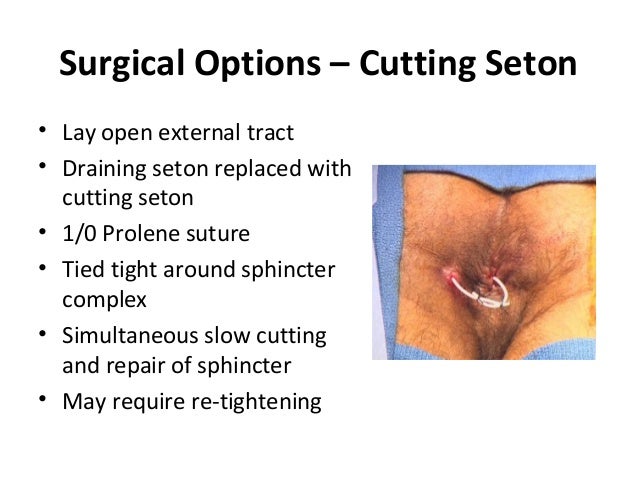 Wound Care For An Anal Fistulotomy 32