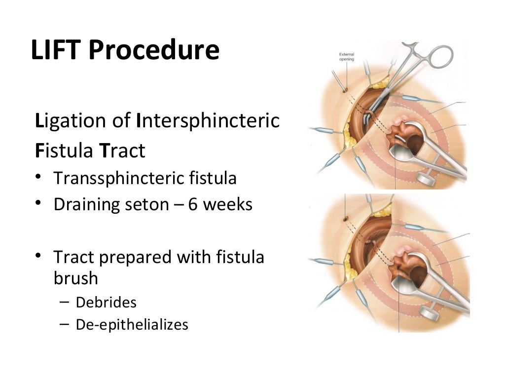 Fistula In ano Fistula In ano