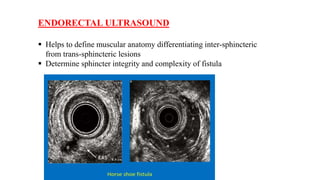 FISTULA-IN-ANO.pptx