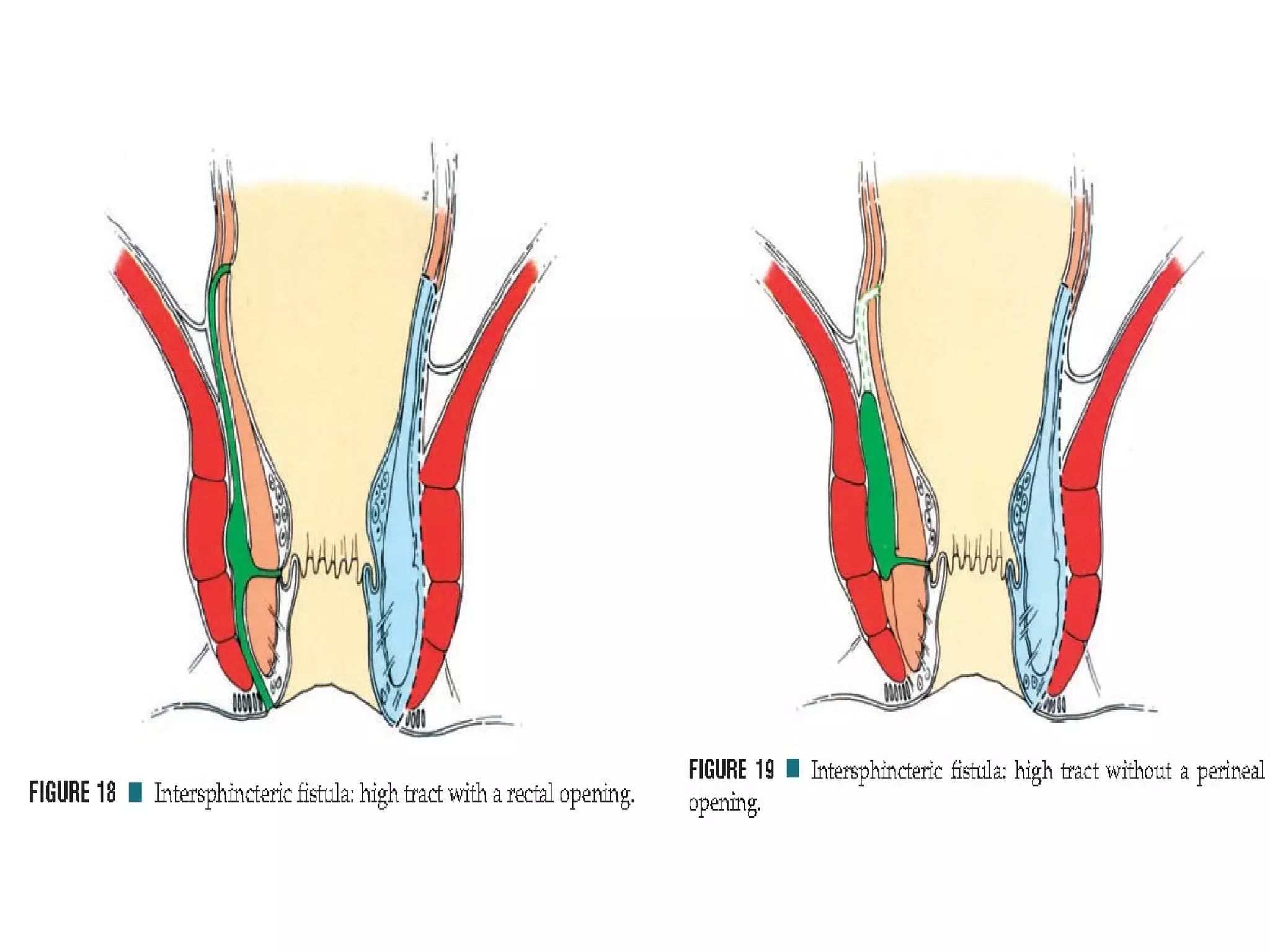 Fistula in-ano | PPT