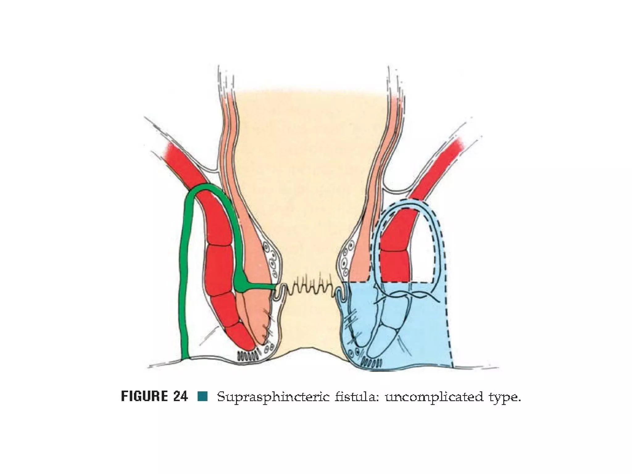 Fistula in-ano | PPT