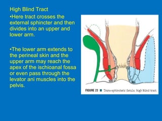High Blind Tract
•Here tract crosses the
external sphincter and then
divides into an upper and
lower arm.
•The lower arm extends to
the perineal skin and the
upper arm may reach the
apex of the ischioanal fossa
or even pass through the
levator ani muscles into the
pelvis.
 