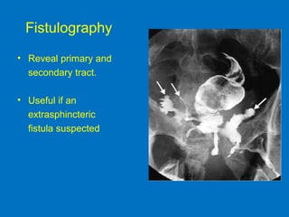 Fistulography
• Reveal primary and
secondary tract.
• Useful if an
extrasphincteric
fistula suspected
 