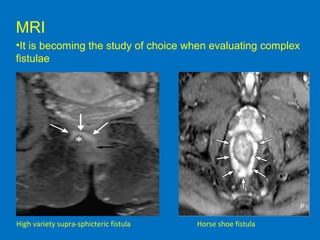 MRI
•It is becoming the study of choice when evaluating complex
fistulae
High variety supra-sphicteric fistula Horse shoe fistula
 