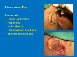 Advancement Flap
Anodermal
• Fistula tract probed
• Flap raised
– Anodermal
• Flap advanced & sutures
• External defect closed
 