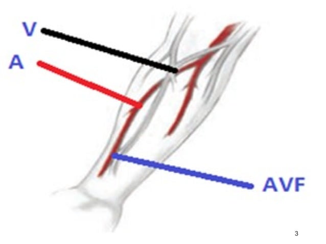 Fistula (Arteriovenous fistula -AVF) | PPT