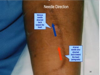 Fistula (Arteriovenous fistula -AVF) | PPT