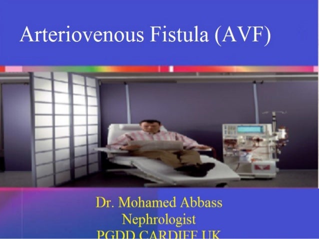Fistula Arteriovenous Fistula Avf - 