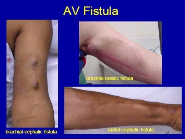 tipos-de-fistula