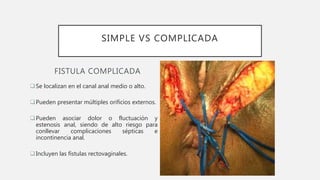 SIMPLE VS COMPLICADA
FISTULA COMPLICADA
Se localizan en el canal anal medio o alto.
Pueden presentar múltiples orificios externos.
Pueden asociar dolor o fluctuación y
estenosis anal, siendo de alto riesgo para
conllevar complicaciones sépticas e
incontinencia anal.
Incluyen las fístulas rectovaginales.
 
