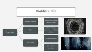 DIAGNOSTICO
Imagenología
Ecografia endoanal
Detecta orificio interno
hasta en un 94%
RNM
Fistulas complejas,
recurrentes y asociadas a
Crohn
Fistulografia
Dificil interpretación
Solo en fistulas
complejas
 